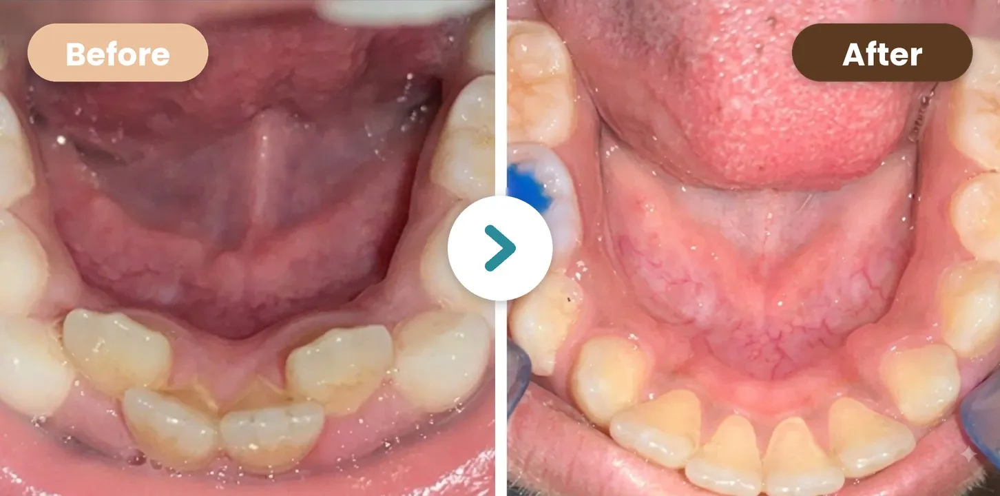 Dental Whitening