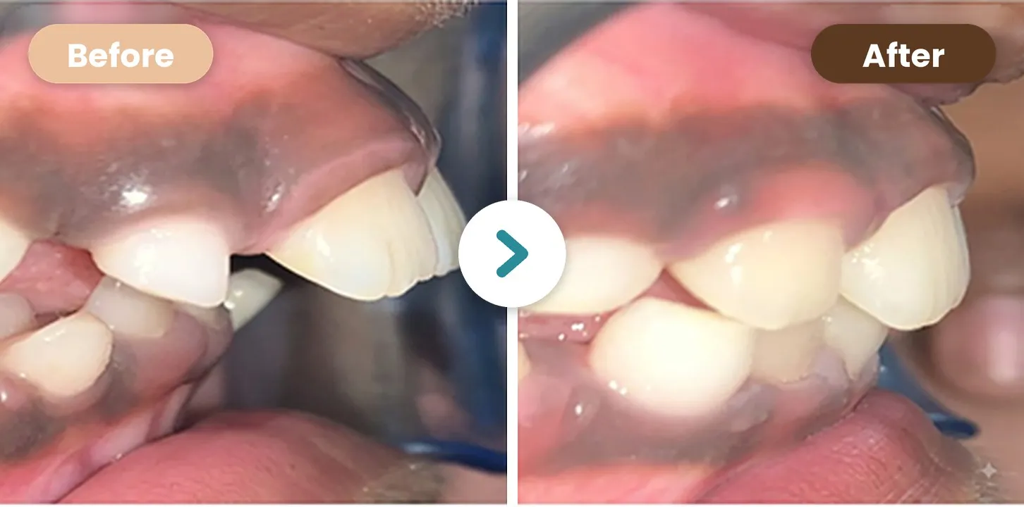 Smile Makeover