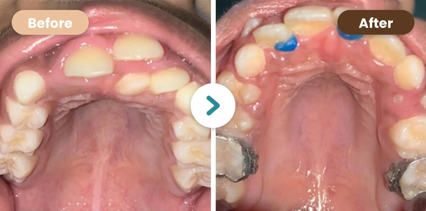 Dental Whitening